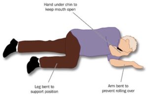 patient placed in the recovery position to ensure a clear airway for adequate breathing and to prevent inhalation of vomit.