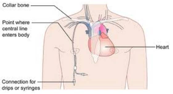 central venous catheter