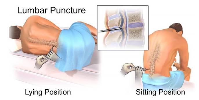 Lumbar Puncture Information Milton Keynes University Hospital