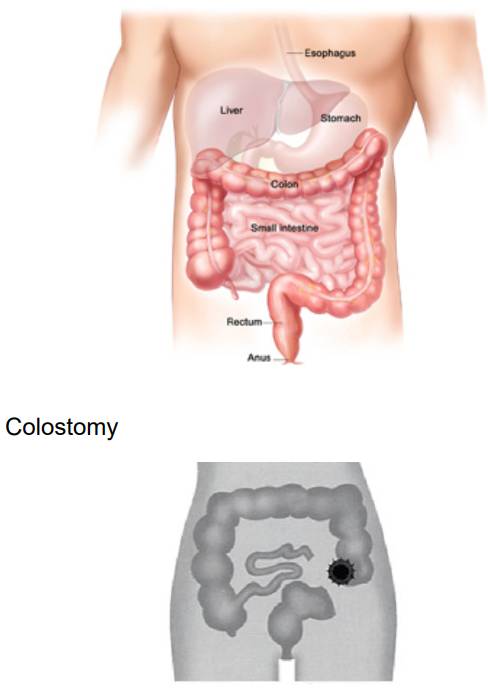Colostomy - Wikipedia