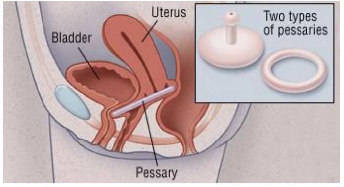 Vaginal pessary for prolapse what is a vaginal
