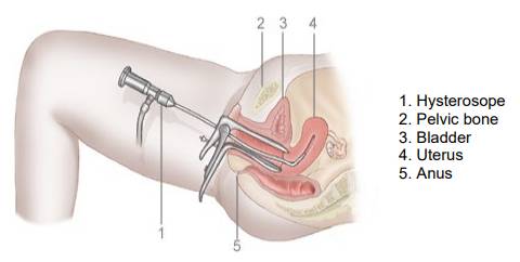 Hysteroscopy Under General Anaesthesia - Milton Keynes University Hospital