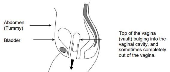 Sacrocolpopexy For Vault Prolapse Milton Keynes University Hospital