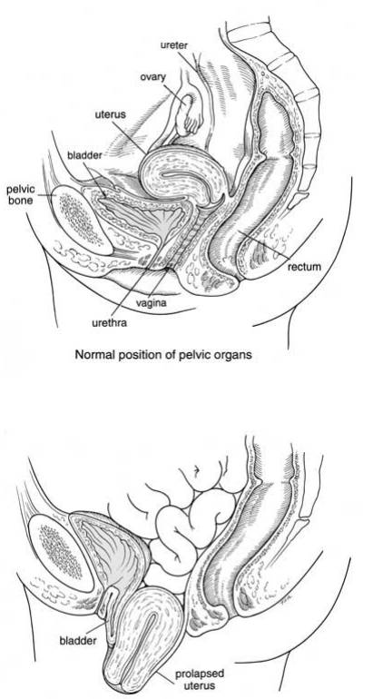 Vaginal Hysterectomy for Uterine Prolapse and Vaginal Repair - Milton  Keynes University Hospital