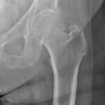 femoral_neck_fracture_-_valgus_impacted_1a
